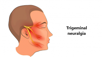 The most painful trigeminal neuralgia in humans, therapeutic target is coming